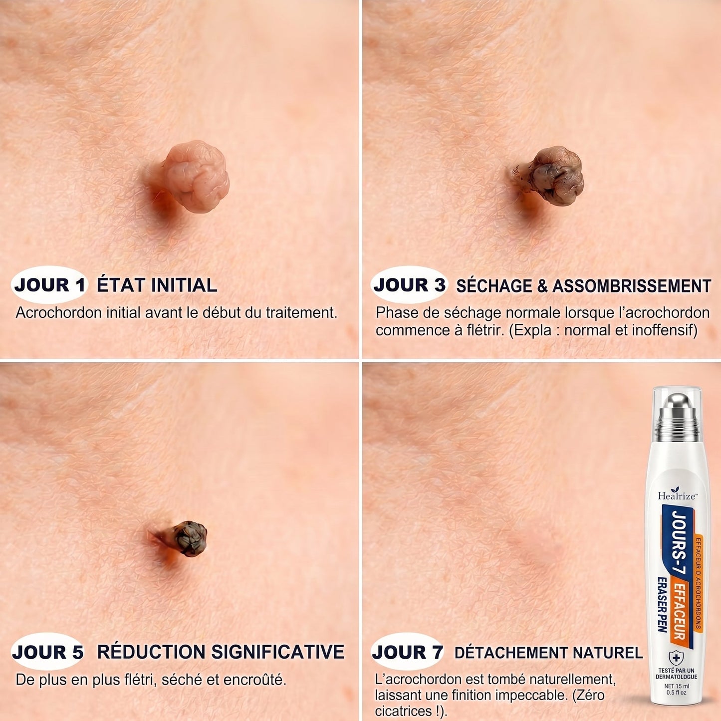Recommandé par les pharmaciens 👨‍⚕️👨‍⚕️ 𝑯𝗲𝙖𝐥𝒓𝗶𝙯𝗲® 7-Day Tag & Spot Eraser 🪄 (Rollerball sans douleur, sans marques) 👩‍⚕️