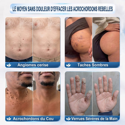 Recommandé par les pharmaciens 👨‍⚕️👨‍⚕️ 𝑯𝗲𝙖𝐥𝒓𝗶𝙯𝗲® 7-Day Tag & Spot Eraser 🪄 (Rollerball sans douleur, sans marques) 👩‍⚕️